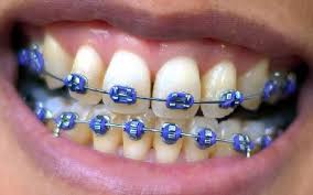 I Just Got Result Purple On Quiz What Colour Train Track Braces Should I Get What Will You Get Fake Braces Braces Colors Dental Braces