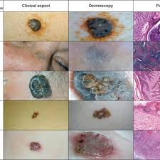 What does a keratosis look like. The Five Main Subtypes Of Seborrheic Keratosis Pathological Pictures Download Scientific Diagram