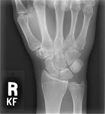 Image result for Scapholunate Dislocation