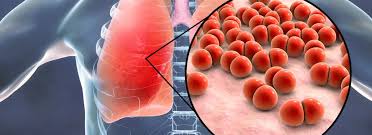 Image result for Pneumonia