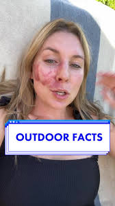 Basketball birthmarks is the new vascular birthmarks 🤣 #portwinestain