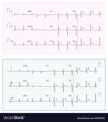 Heart Cardiogram Chart Set Healthy Heart