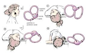 Studies show that the epley maneuver is effective for relieving dizziness caused by benign paroxysmal. Epley Maneuver Exercises For Vertigo Ent Clinic