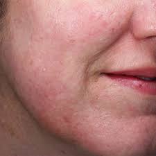 How To Reduce Redness On Your Face | Script Skincare