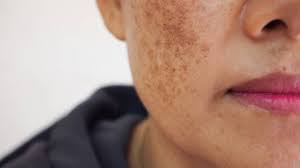 Everything You Need To Know About Getting Rid Of Freckles | Vdg