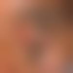 Image result for cornu cutaneum)