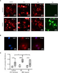 We did not find results for: Frontiers Hypoxia Promotes A Mixed Inflammatory Fibrotic Macrophages Phenotype In Active Sarcoidosis Immunology