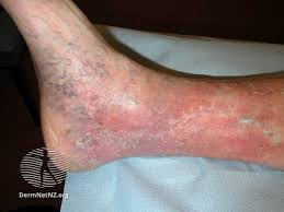 Image result for Stasis Dermatitis
