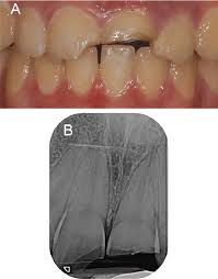 Image result for Tooth Fracture