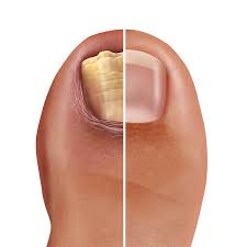 Image result for onychomycosis