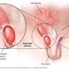Normally the abdomen and groin are kept separate by a wall of muscle and tissue. 3