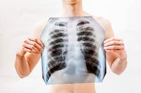 Penyakit ini bisa muncul karena di akibatkan oleh virus, bakteri, jamur maupun parasit yang dimana pulmonary alveolus (alveoli) yang bertanggung jawab untuk menyerap oksigen dari atmosfer menjadi. Waspadai 8 Gejala Paru Paru Basah Ini Sejak Dini Wecare Id