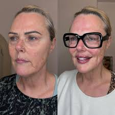 One of the most challenging dissolve and refill treatments I've done to  date and I'm all about keeping it real 🤝 This lovely client came in for a  consultation, unsure about her