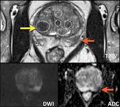 However, as with other types of cancer,. The Radiology Assistant Prostate Cancer Pi Rads V2