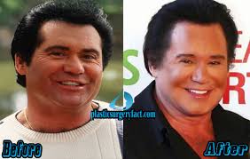 It's an unbelievable achievement to have no wrinkles around the eyes in . Wayne Newton Plastic Surgery Before And After Photos Plastic Surgery Facts