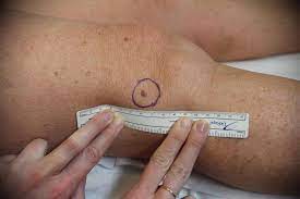 Skin cancer is one of the most common types of cancer. Melanoma Victoria Skin Cancer Screening Early Diagnosis Skin Cancer Screening Victoria Bc