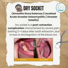 Image result for Alveolitis sicca)