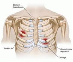 The ribs are the skeletal protection for the lungs and the chest cavity. Rib Fracture And Pneumothorax Complication Sportsmd
