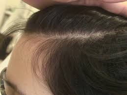 The most common type of hair loss is the kind. Hereditary Hair Loss Alopecia Androgenetica Thymuskin