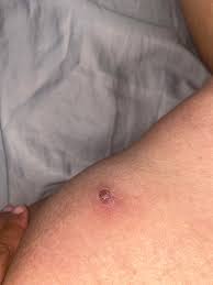 However, not shaving too closely by using an electric razor can. I Had A Really Bad Ingrown Hair On My Inner Thigh For Several Months But Never Had Luck Getting It Out Until Using Some Glycolic Acid Overnight The Next Day I Got