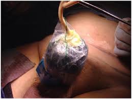 Fournier's gangrene is a urological emergency with a high mortality rate despite advances in the medical and surgical fields. Fournier S Gangrene Causes Symptoms Diagnosis And Treatment