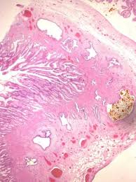 Adenomyosis is defined as the presence of ectopic nests of endometrial glands and stroma within the myometrium, surrounded by reactive smooth muscle hyperplasia. Adenomyomatosis Of The Gallbladder Radiology Reference Article Radiopaedia Org