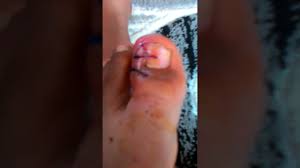 Tirnak Ameliyatindan Sonra Youtube