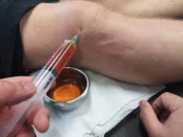 Image result for Prepatellar Bursitis