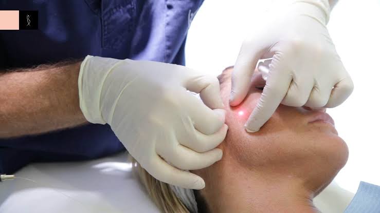 Endolift Treatment: How It Works, Recovery, and Side Effects