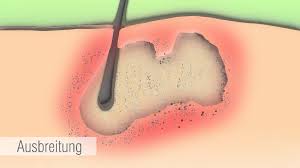 Wie entstehen pickel auf den schamlippen? Acne Inversa Symptome Und Verlauf Youtube