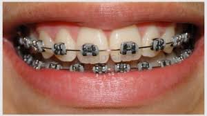 Tramento Com Aparelho Mal Feito Pode Levar A Perda De Dentes Saudaveis