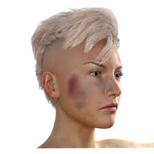 What Do The Colours Of Bruises Signify Desan Academy Chronic Fatigue Syndrome Symptoms Chronic Fatigue Symptoms Chronic Fatigue