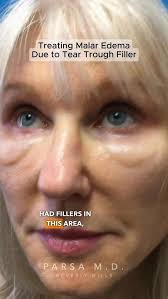 If you have chronic swelling after under-eye HA filler, or if your practice  sees patients with this condition, we just published a paper