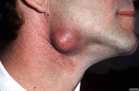 Image result for inflamed neck and face