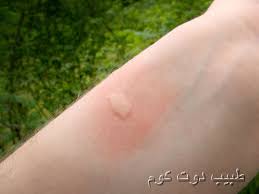 لدغات لسعات عضات وقرصات الحشرات Insect Bites And Stings طبيب دوت كوم