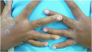 Image result for scabies transmission