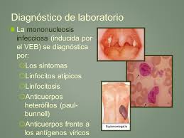 Típicamente ocurre en adolescentes, pero se puede. Virus De Epstein Barr Pagina 3 Monografias Com