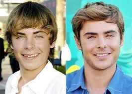 Celebrity teeth before & after: Zac Efron Braces Celebrity Smiles Celebrity Teeth Celebrities With Braces