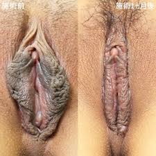 女性器 20代の症例写真・画像・ビフォーアフター｜美容整形・美容外科のTAクリニックグループ