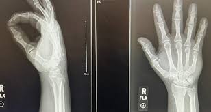 Image result for Wrist XRay