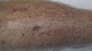 The spots may also appear on organs or mucous. Petechiae Causes Treatments Pictures And More