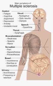 Multiple sclerosis is a disease of the central nervous system that results in the malfunctioning of the brain's communication with the nerves. Symptoms Of Multiple Sclerosis Esclerosis Multiple Del Sistema Nervioso Hd Png Download Transparent Png Image Pngitem