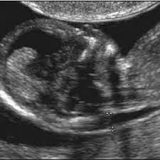 As the nt increases, so does the risk of your baby having chromosomal abnormalities. Pdf First Trimester Screening