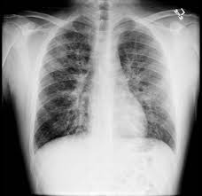 A Man In His 20s With Diffuse Lung Opacities And Acute Respiratory Failure After Hookah Smoking Chest
