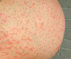 Image result for pruritic urticarial papules and plaques of pregnancy