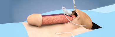Protese Peniana Curitiba Clinica Griffon