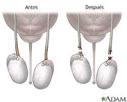 Antes Y Despues De La Vasectomia Medlineplus Enciclopedia Medica Illustracion