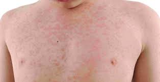 Si configura un quadro di scarlattina quando, oltre alle manifestazioni streptococciche che colpiscono la mucosa orale, si manifesta un esantema.un bambino su 10 di età compresa fra 5 e 15 anni colto dalla faringite streptococcica sviluppa la scarlattina. Scarlattina Contagio Sintomi E Terapia Biopills