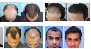 Salman khan's hair transplant experience. Hair Transplant In Bollywood Posts Facebook