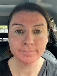 Un]reasonably outraged … about adult acne — KYLIE ORR